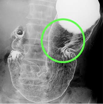胃X線検査　早期胃癌