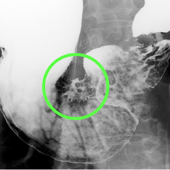 胃X線検査　早期胃癌