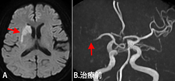 【図5_1】急性期脳梗塞に対する脳血管内治療（IVR） 60歳代男性